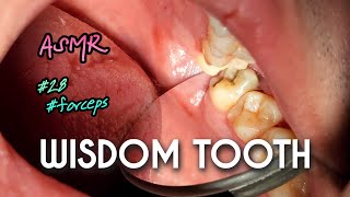 ASMR Decayed Wisdom Tooth Extraction 4k [upl. by Samaj]