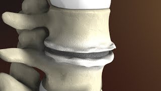 Degenerative Disc Disease Spondylosis explained by Spine Surgeon Dr Jessica Shellock Plano TX [upl. by Osrock]