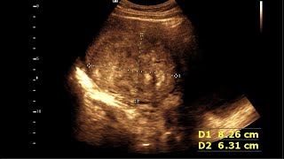 Uterine leiomyoma  Fibroid Uterus  FIGO Classification [upl. by Eentirb]