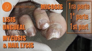 Mycosis and nail lysis Part 1 Micosis y lisis ungueal Parte 1 Micose Podología Integral [upl. by Earahc978]