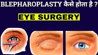 How Blepharoplasty Is Performed  Blepharoplasty  Eyelid Surgery Animation [upl. by Jamaal]