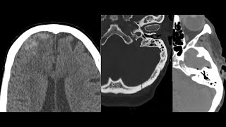 Complexed intracranial hemorrhage pneumocephalus and skull fracture [upl. by Kawasaki]