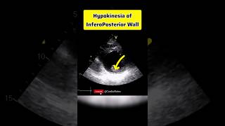 Hypokinetic InferoPosterior Wall anatomy heartphysiology heart echocardiagram [upl. by Wyon]