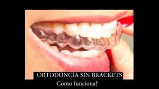 como funciona la Ortodoncia Sin Brackets [upl. by Froehlich]