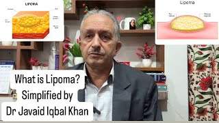 What is Lipoma [upl. by Schacker772]