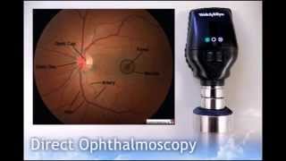 Direct Ophthalmoscopy [upl. by Aikit]