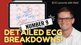 Improve your EKG Skills test yourself  ECG No 9 [upl. by Akinot]