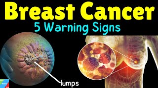 💗What are the 5 Warning Signs of Breast Cancer  What are the Symptoms of Breast Cancer [upl. by Sherman258]