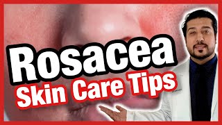 5 Quick Ways to Get Rid of Rosacea FAST  How to Get Rid of Rosacea 2021 [upl. by Tootsie769]