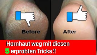 5 erprobte Tricks um extreme Hornhaut zu entfernen [upl. by Dloreh]