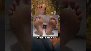 Easy Home Remedy for Toenail Fungus [upl. by Butterfield670]