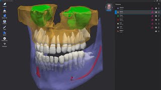 🇬🇧 Implant 3D JarvisArtificial intelligence in dentistry [upl. by Burnaby]