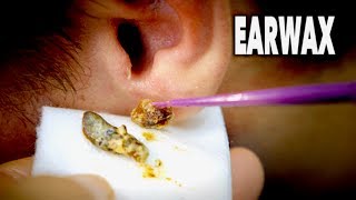 THE BEST EARWAX REMOVAL EVER and most gross  Dr Paul [upl. by Elianora169]