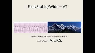 ACLS 2020 Algorithm Tachycardia [upl. by Enneirda]