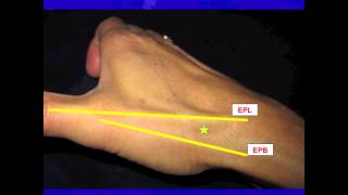 Thumb CarpalMetacarpal CMC Joint injection [upl. by Niledam]