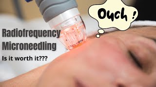 Radiofrequency Microneedling  Does it actually work  Dermatologist reviews [upl. by Einahpats856]