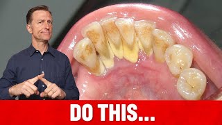 The 1 Top Remedy for Dental Plaque TARTAR [upl. by Noah]