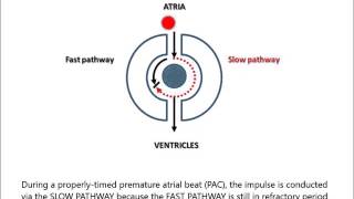 AV Nodal Reentry Tachycardia AVNRT for noncardiologist in less than 2 minutes [upl. by Louis]