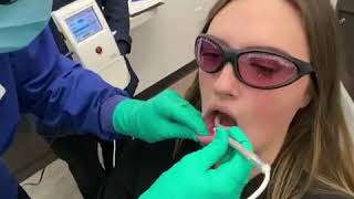 Laser treatment for cold sores and canker sores [upl. by Proffitt]