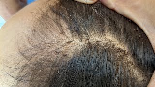 Remove many lice from brown hair  Plucking most of lice from head [upl. by Zaccaria]