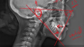 12 Tweed triangle Cephalometric analysis [upl. by Martha452]