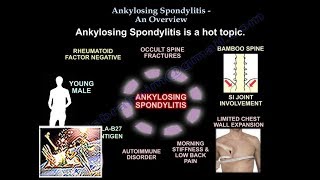 Ankylosing Spondylitis An Overview  Everything You Need To Know  Dr Nabil Ebraheim [upl. by Brunk]