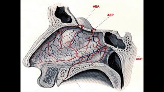 ORL EPISTAXIS 2 [upl. by Llehsar]