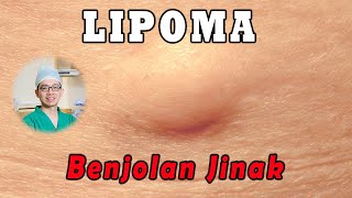 LIPOMA Tumor Jinak  Benjolan Lunak [upl. by Elehcin731]