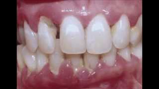 Periodontitis  Cure your Gum with Dr Mark Bonner [upl. by Oinoitna942]