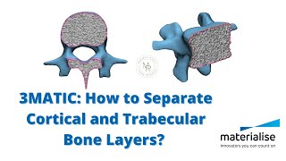 3MATIC  How to separate cortical layer in vertebra  تفکیک لایه های استخوانی [upl. by Cone15]