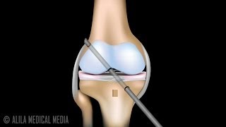 ACL Reconstruction Surgery Animation [upl. by Hernando]