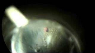 Laser Peripheral Iriditotomy to Prevent Glaucoma Part 2 [upl. by Annabella]