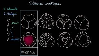 Sténose aortique  Docteur Synapse [upl. by Nuaj]