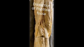 Popliteal fossa Dissection of popliteal fossa Anatomy of popliteal fossa Contents popliteal fossa [upl. by Feeney419]