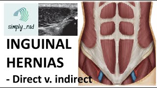 Inguinal hernias in under 2 minutes [upl. by Niarb]