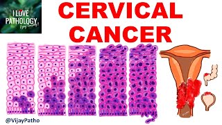 Squamous Intraepithelial lesion amp CANCER CERVIX [upl. by Sandell121]