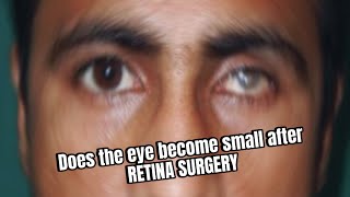 Does the EYE BECOME SMALL after Retina Surgery retinaldetachment [upl. by Htennaj]