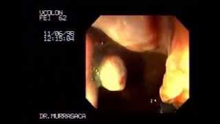 Video Hemorrhoids rubber band ligation 3 [upl. by Algy658]