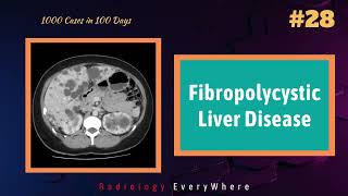 Fibrocystic liver diseases Radiology  1000 cases in 100 days  video 28  Radiology Everywhere [upl. by Attevad40]