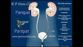 Animation of RIRS for Kidney Stone [upl. by Brewster]