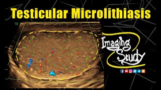 Testicular Microlithiasis  Ultrasound  Case 334 [upl. by Posner]