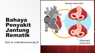 Bahaya Penyakit Jantung Rematik  Rheumatic Heart Disease Patofisiologi Penyakit Jantung Rematik [upl. by Kronick]