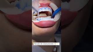 Sessão de clareamento dental em Brasília dentista asanorte asasul aguasclarasdf [upl. by Cheatham103]