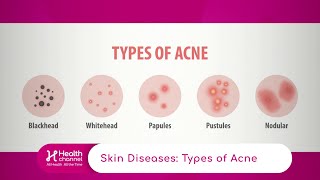 Types of Acne [upl. by Han]