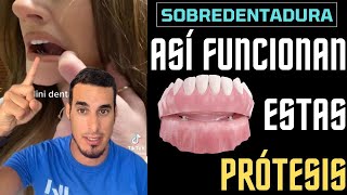 Así funciona esta PRÓTESIS DENTAL  Sobredentadura con implantes [upl. by Latona]