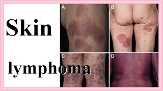 skin lymphoma [upl. by Marrilee]