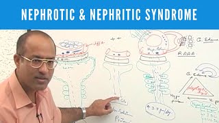 Nephrotic and Nephritic Syndrome  Causes Symptoms amp Treatment🩺 [upl. by Glynn]