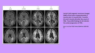 Neurology Quiz 95 Progressive multifocal leukoencephalopathy PML [upl. by Nedloh]