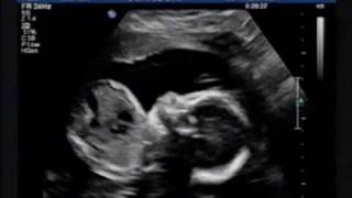 Ultrasound 23 Weeks [upl. by Lanza]