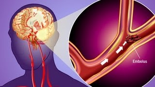 Stroke Prevention amp Transient Ischemic Attack TIA [upl. by Seta]